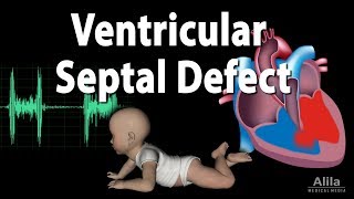 Ventricular Septal Defect Animation [upl. by Dawn]