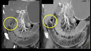 Stools stuck in abdomen  Small Intestinal Obstruction Dr Rajasekhar M R  Doctors Circle [upl. by Dazraf]