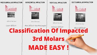 Classification of Impacted 3rd Molars  Oral Surgery [upl. by Layla110]