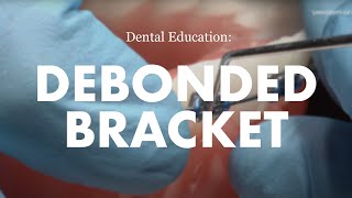 Orthodontic Emergencies How to remove a debonded bracket from a fixed orthodontic appliance brace [upl. by Carolin]