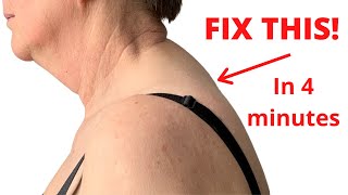 Quick 4minute fix for Neck Hump Buffalo hump or a Dowagers hump [upl. by Eidnew]