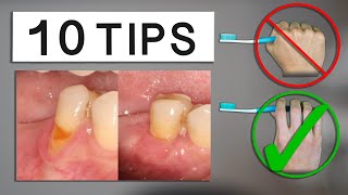 10 Tips to Minimize Gum Recession at Home [upl. by Liam710]