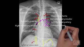 Chest xray Normal  Chest xray interpretation normal anatomy on a CXR [upl. by Akelahs]