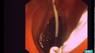 OvertheWire Stent Exchange Using a Simple Snare Technique in ERCP [upl. by Akinorev]