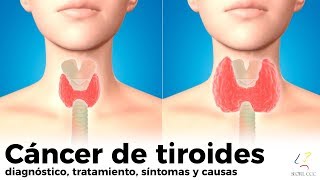 CÁNCER DE TIROIDES diagnóstico tratamiento síntomas causas [upl. by Esilanna]