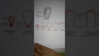 Comparison retraction ring Bandls ringconstriction ring [upl. by Pearla]