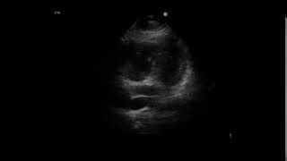 Right Ventricular Dilation Submassive PE Ultrasound Four chamber view alternate example [upl. by Armstrong]