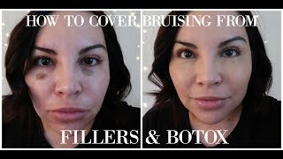 HOW TO COVER BRUISING FROM FILLERS amp BOTOX [upl. by Ahsar]