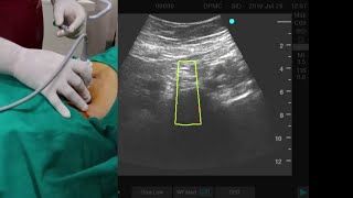 ULTRASOUND GUIDED SUPERIOR HYPOGASTRIC PLEXUS BLOCK USG  ULTRASOUND GUIDED [upl. by Florie]