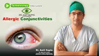 Allergic conjunctivitis  Ophthalmology  Signs and Symptoms  Diagnosis and Treatment [upl. by Ahsie]