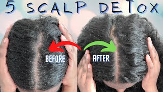 5 DIY DETOX amp SCALP EXFOLIATION FOR HEALTHY HAIR GROWTH How to Fix An Itchy Flaky Dry Scalp [upl. by Einrae337]