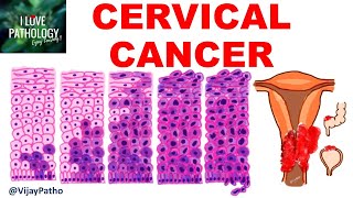 Squamous Intraepithelial lesion amp CANCER CERVIX [upl. by Threlkeld165]