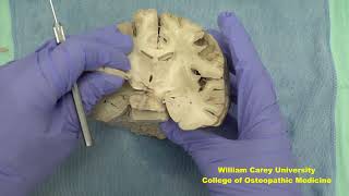 Coronal forebrain first videoneuroanatomy forebrainhypothalamushumanbrainbrainhumanbrain [upl. by Irish]