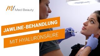 FaceContouring mit Hyaluron [upl. by Eliot]