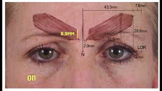 Indepth Guide To Treating The GlabellaForehead With Botox  Dr Chris Hutton [upl. by Htiaf93]