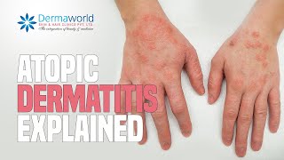 How to treat Contact Dermatitis on fingertips  Dr Aruna Prasad [upl. by Kimbell443]