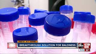 California lab creating cure for baldness using cell cloning process [upl. by Pattison]