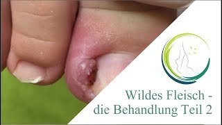 Wildes Fleisch die Behandlung Teil 2 [upl. by Waylon478]