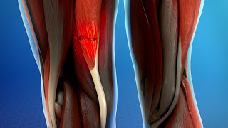 Hamstring Muscle Injuries [upl. by Bethanne800]