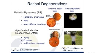 A Stem CellBased Therapy for Retinitis Pigmentosa [upl. by Nothgiel336]