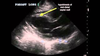 Apical ischemia [upl. by Netsirt]