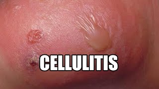 Cellulitis What is it Treatments Causes and Symptoms [upl. by Nadda]