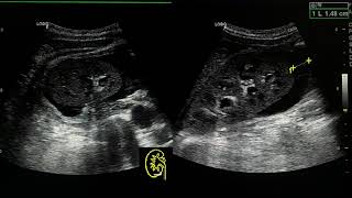 acute pyelonephritis ultrasound case [upl. by Salohci]