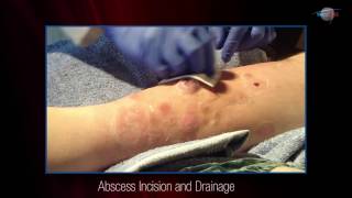 WCW Abscess Incision and Drainage [upl. by Llenrup]