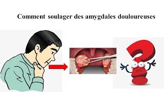 Comment soulager des amygdales douloureuses  Santé générale [upl. by Noryb859]