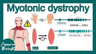 Myotonic Dystrophy  signs and symptoms pathophysiology treatment of Myotonic Dystrophy [upl. by Jamnes442]