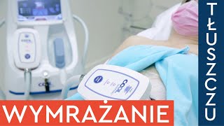 Jak działa kriolipoliza CoolShaping Pokazujemy zabieg wymrażania tłuszczu na brzuchu [upl. by Kliman309]