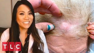 Removing a Boston Cherry Cyst  Dr Pimple Popper This is Zit [upl. by Craw]