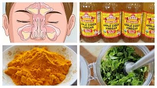 Best Natural Home Remedies for Sinusitis [upl. by Birchard]