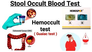 Stool for occult blood test  Hemoccult test  Guaiac test  FOBT [upl. by Warrenne640]