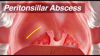 Peritonsillar Abscess  Identification and Treatment [upl. by Enirehtac]