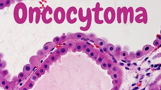 PTERYGIUM verry IMPORTANT conjuctival condition explanation with scenario [upl. by Woodford126]