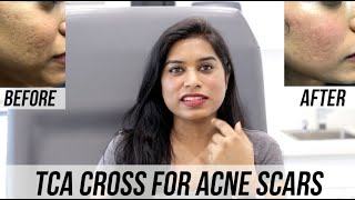 TCA Cross for Acne Scars [upl. by Solitta370]