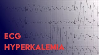 Hyperkalemia EKG Findings  ECG Interpretation [upl. by Odnuges]