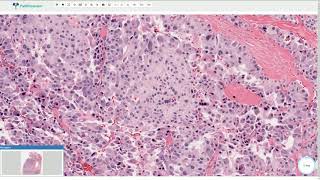 Medullary Carcinoma  Thyroid Gland Histopathology [upl. by Ojyma]