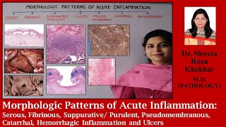 Morphologic Patterns of Acute Inflammation Serous Fibrinous Suppurative Inflammation and Ulcers [upl. by Yendic]