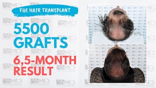 Manual FUE Hair Transplant Before amp After 5500 Grafts 65Month Result  ASMED  Dr Koray Erdogan [upl. by Brigg614]