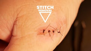 How to Remove Stitches from Home [upl. by Adabelle376]