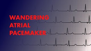 Wandering Atrial Pacemaker  EKG ECG Interpretation [upl. by Aurore]