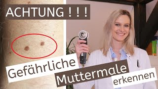 Gefährliche Muttermale  Hautkrebs  DermaQuickTipp  Ersteinschätzung  Untersuchung [upl. by Emelun72]