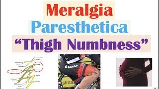 Meralgia Paresthetica “Numbness of the Thigh”  Causes Symptoms Diagnosis Treatment [upl. by Sidonius]