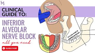 Inferior alveolar nerve block technique [upl. by Guise]