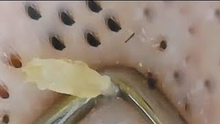 Big Old Blackhead Removal Video [upl. by Drucill256]