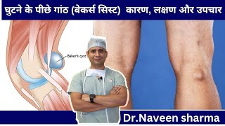 Knee swelling in back of knee  backer cyst treatment what is knee swelling [upl. by Rumney]