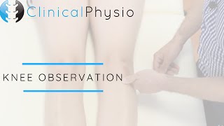 Observation of the Knee Joint  Clinical Physio [upl. by Ynaitirb]