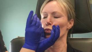 Botox in the neck for a smoother tighter look [upl. by Ellehc]